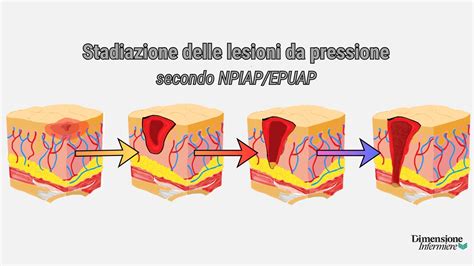 Diagramma illustrativo degli stadi delle lesioni da pressione