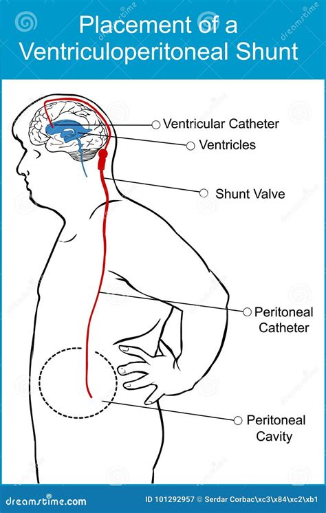 Schema di uno shunt ventricolo-peritoneale