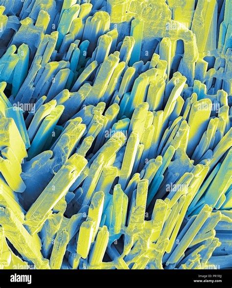 Microscopio che mostra cristalli di colesterolo nella bile