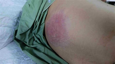 Immagine di una piaga da decubito in stadio iniziale