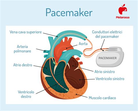Schema pacemaker fisiologico