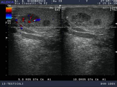 Diagramma degli stadi del seminoma testicolare