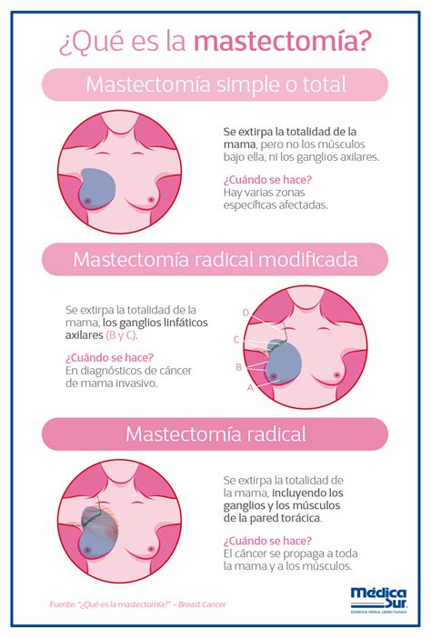 Diagramma di quadrantectomia e mastectomia
