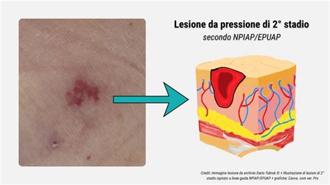 Immagine di lesione cutanea da ectima gangrenoso