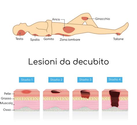 Diagramma che illustra le zone del corpo più a rischio di piaghe da decubito