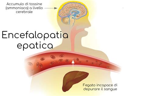 Diagramma che illustra i sintomi dell'encefalopatia epatica nei diversi stadi
