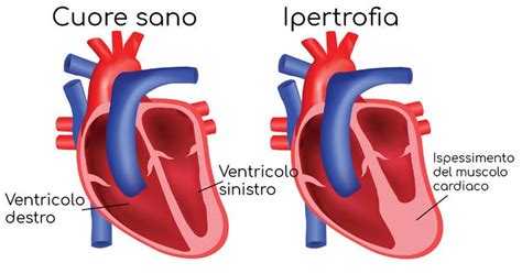 Cuore sano vs cuore con disfunzione ventricolare sinistra