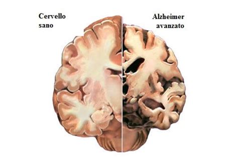 Illustrazione di un cervello sano contrapposto a un cervello affetto da Alzheimer, evidenziando le aree colpite.