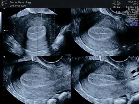 Ecografia pelvica con utero e ovaie