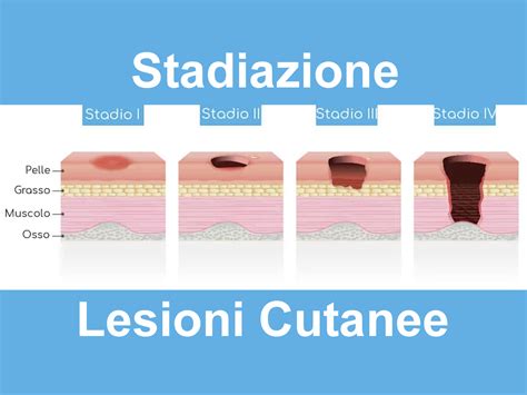 Schema degli stadi delle lesioni da decubito