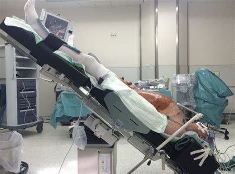 Paziente in posizione di Trendelenburg su un tavolo operatorio