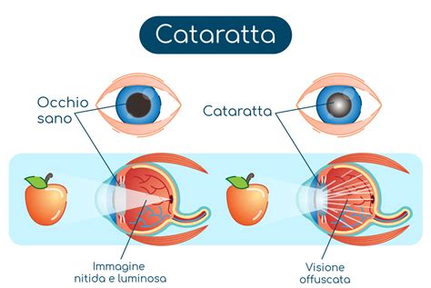 Immagine che mostra un occhio con cataratta e un occhio sano