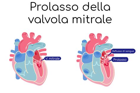Ecocardigramma che mostra prolasso della valvola mitrale