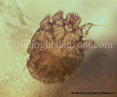 Illustrazione microscopica dell'acaro della scabbia