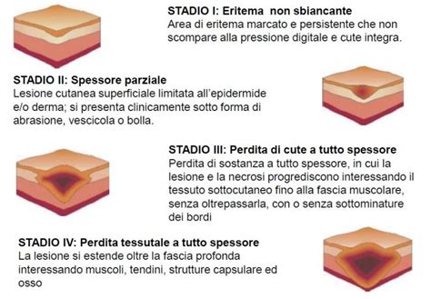 Primo piano di una medicazione avanzata su una lesione da decubito