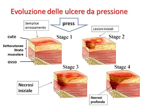 Diagramma anatomico che evidenzia le prominenze ossee più colpite dalle lesioni da decubito