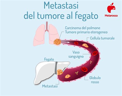 Diagramma che illustra la differenza tra tumore primario del fegato e metastasi epatiche
