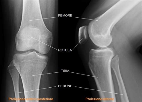 Radiografia del ginocchio che mostra depositi di calcio nella cartilagine