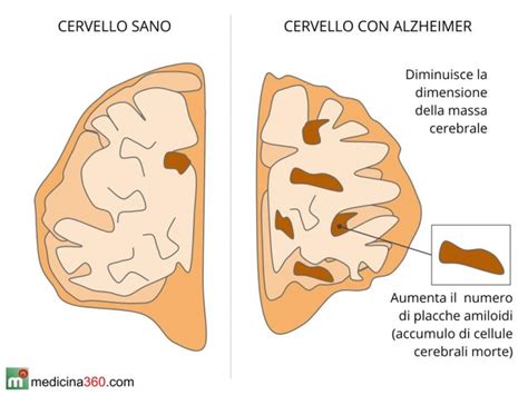 Diagramma che illustra la progressione della malattia di Alzheimer e i suoi effetti cognitivi