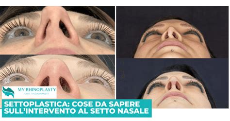 Confronto visivo tra settoplastica e rinoplastica