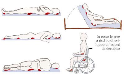Diagramma anatomico che evidenzia le zone del corpo più a rischio di piaghe da decubito
