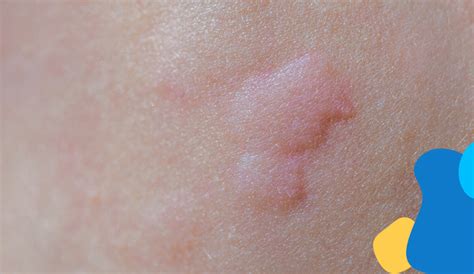 Anziano con eritema da pannolone