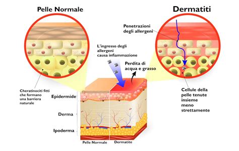 Illustrazione delle cause della dermatite da pannolone