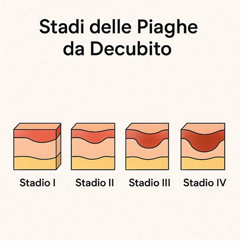 Diagramma a stadi che illustra la progressione delle piaghe da decubito