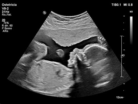 Ecografia fetale in movimento