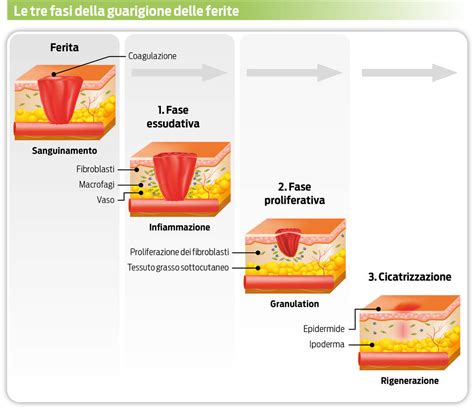 Diagramma che illustra le fasi di guarigione di una lesione da pressione
