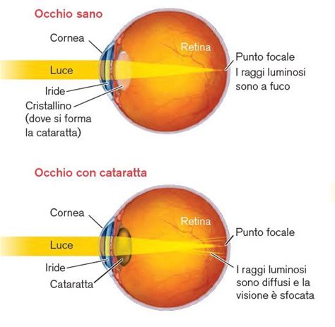 Occhio sano contrapposto a un occhio con cataratta