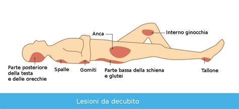 Paziente con lesione da decubito a letto