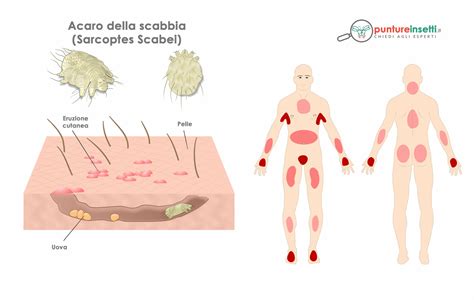 Schema anatomico della pelle con evidenziate le aree colpite dalla scabbia