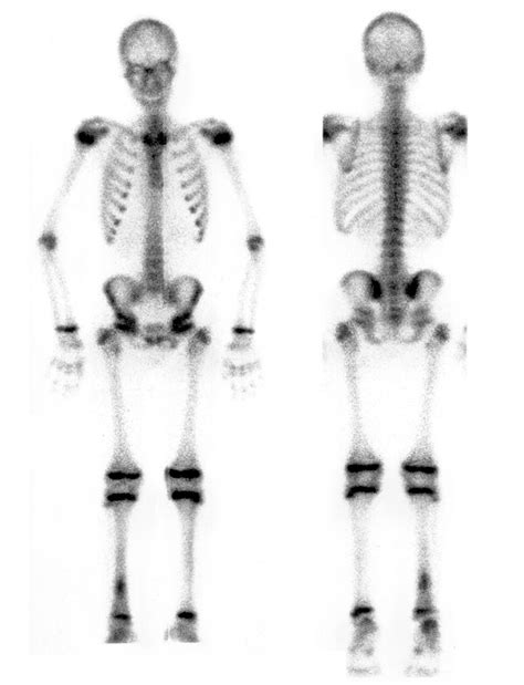 Immagine scintigrafica ossea che mostra aree di aumentato accumulo del radiofarmaco