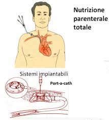 paziente che riceve nutrizione parenterale a domicilio