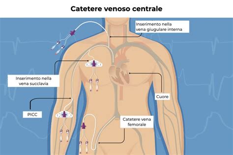schema di catetere venoso centrale tunnellizzato