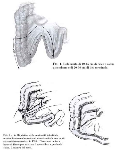 Schema della cistectomia radicale con derivazione urinaria