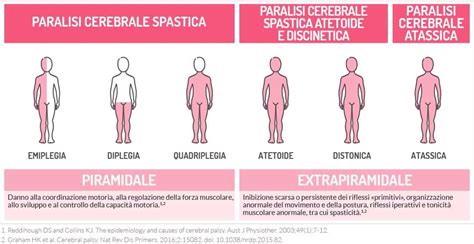 Diagramma che illustra le diverse tipologie di paralisi cerebrale infantile e le loro caratteristiche principali