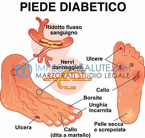 Immagine stilizzata di un piede diabetico con frecce che indicano aree di alta pressione