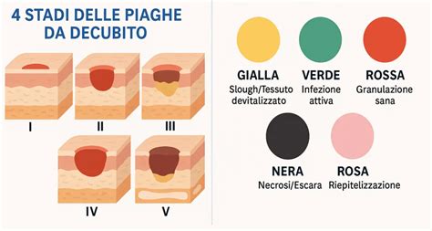 Schema grafico che illustra i quattro stadi delle piaghe da decubito