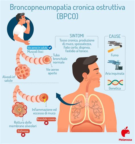 Grafico che illustra la progressione della BPCO