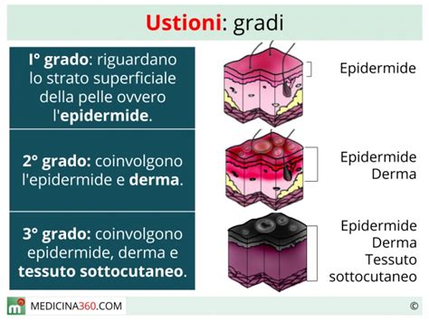 Illustrazione di diversi gradi di ustione sulla pelle