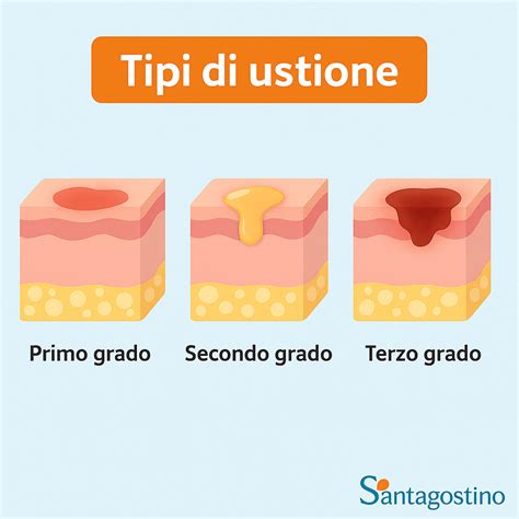 Illustrazione di un'ustione di secondo grado con vesciche