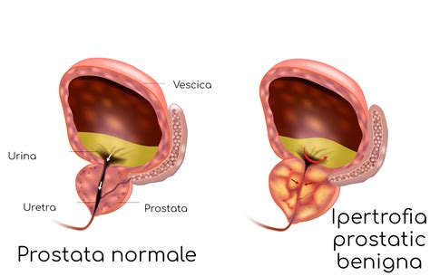 Diagramma che illustra l'ipertrofia prostatica benigna e la sua compressione sull'uretra