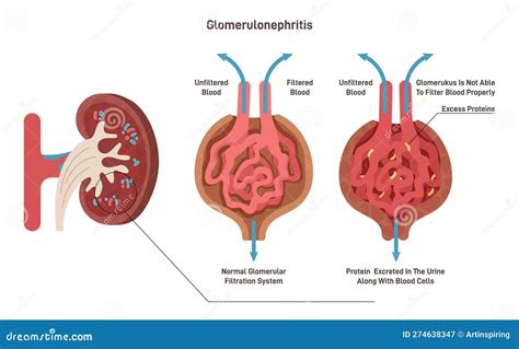 Diagramma di un glomerulo renale sano e di un glomerulo danneggiato dalla nefrite lupica