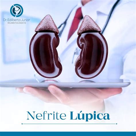 Infografica sui farmaci utilizzati per la nefrite lupica