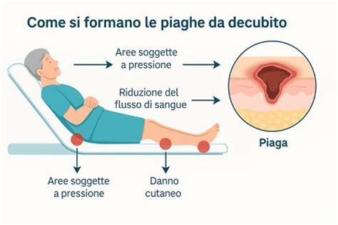 Diagramma che illustra le aree comuni di piaghe da decubito sul corpo umano