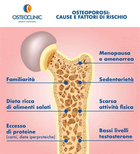 Infografica sui fattori di rischio dell'osteoporosi