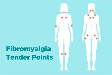 Diagramma che illustra i 18 tender points della fibromialgia