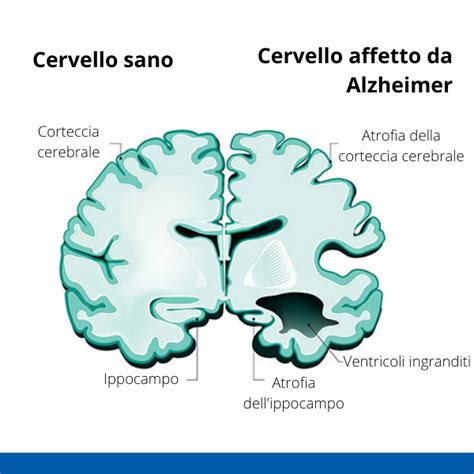 Illustrazione di neuroni in un cervello sano e in uno affetto da demenza